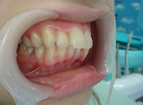 症例写真,オールセラミッククラウン（e-max）の症例写真 上顎の前歯2本を引っ込めたい,Before,ba_ceramic41_b.jpg