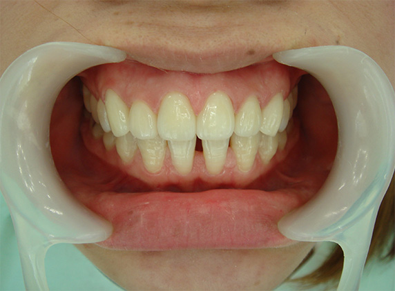 オールセラミッククラウン（e-max）,オールセラミッククラウン（e-max）の症例写真 かみしめた時に前歯が閉じない,After,ba_ceramic46_a01.jpg
