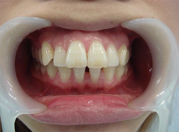 症例写真,オールセラミッククラウン（e-max）の症例写真 かみしめた時に前歯が閉じない,Before,ba_ceramic46_b.jpg