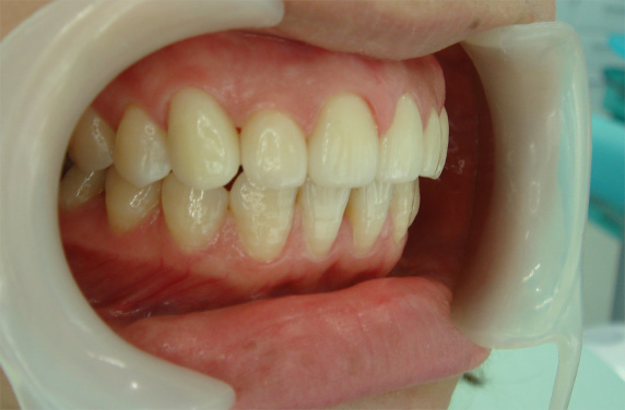 オールセラミッククラウン（e-max）,オールセラミッククラウン（e-max）の症例写真 かみしめた時に前歯が閉じない,After,ba_ceramic47_b.jpg