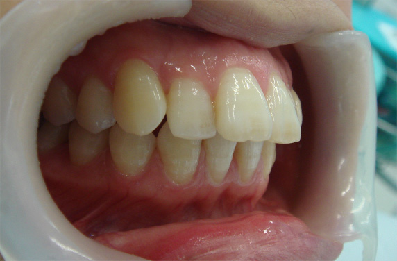 オールセラミッククラウン（e-max）,オールセラミッククラウン（e-max）の症例写真 かみしめた時に前歯が閉じない,Before,ba_ceramic47_b.jpg