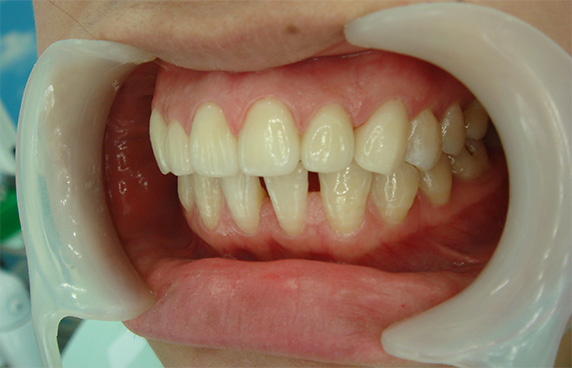 症例写真,オールセラミッククラウン（e-max）の症例写真 かみしめた時に前歯が閉じない,After,ba_ceramic48_b.jpg