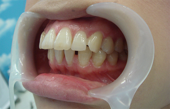 オールセラミッククラウン（e-max）,オールセラミッククラウン（e-max）の症例写真 かみしめた時に前歯が閉じない,Before,ba_ceramic48_b.jpg