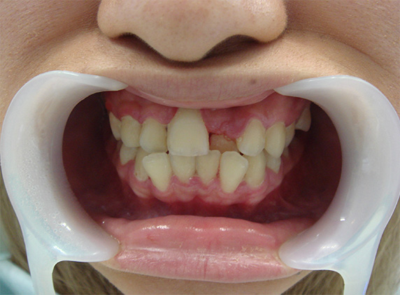オールセラミッククラウン（e-max）,歯のエステ,オールセラミッククラウン（e-max）の症例写真 歯が無いように見えてしまう,Before,ba_ceramic49_b.jpg