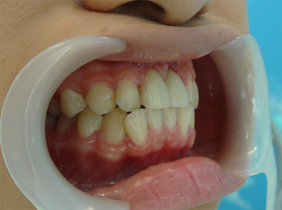 症例写真,オールセラミッククラウン（e-max）の症例写真 歯が無いように見えてしまう,After,ba_ceramic50_b.jpg
