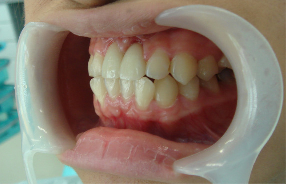 オールセラミッククラウン（e-max）,オールセラミッククラウン（e-max）の症例写真 歯が無いように見えてしまう,After,ba_ceramic51_b.jpg