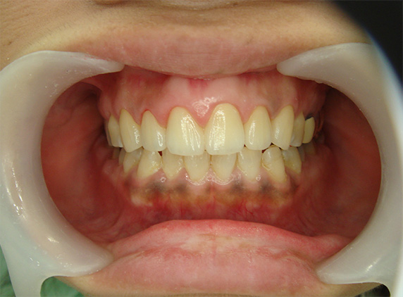 オールセラミッククラウン（e-max）,オールセラミッククラウン（e-max）の症例写真 前歯の中心に段差がある,After,ba_ceramic58_a01.jpg