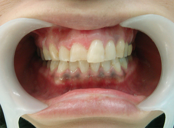オールセラミッククラウン（e-max）,オールセラミッククラウン（e-max）の症例写真 前歯の中心に段差がある,Before,ba_ceramic58_b.jpg