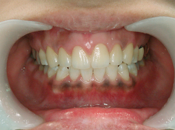 オールセラミッククラウン（e-max）,オールセラミッククラウン（e-max）の症例写真 前歯の中心に段差がある,After,ba_ceramic59_b.jpg