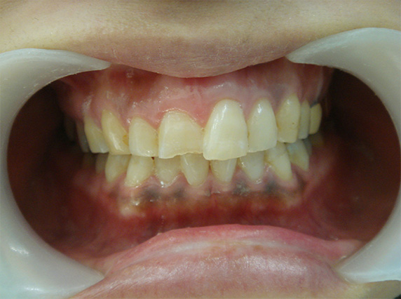 オールセラミッククラウン（e-max）,オールセラミッククラウン（e-max）の症例写真 前歯の中心に段差がある,Before,ba_ceramic59_b.jpg