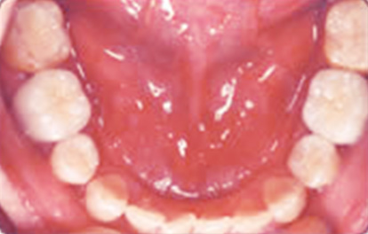 セラミックインレー,セラミックインレーの症例写真 治療痕（銀歯）が目立つ,After,ba_ceramic04_a01.jpg