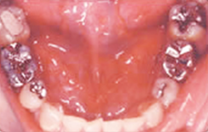 セラミックインレー,セラミックインレーの症例写真 治療痕（銀歯）が目立つ,Before,ba_ceramic04_b.jpg