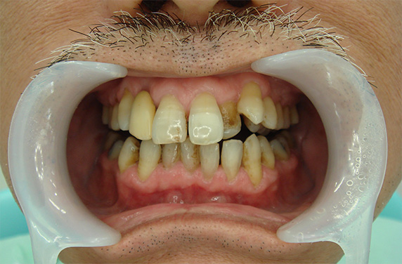 歯のエステ,歯のエステの症例写真,Before,ba_esthe01_b.jpg