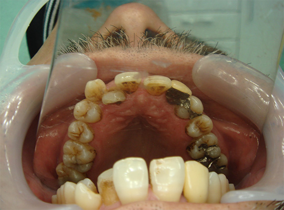 歯のエステ,歯のエステの症例写真,Before,ba_esthe02_b.jpg