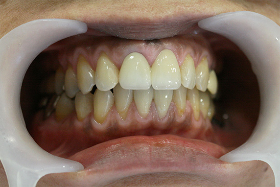 オールセラミッククラウン（e-max）,歯のエステ,歯のエステの症例写真　オールセラミッククラウン（e-max）も施行,After,ba_esthe03_a01.jpg