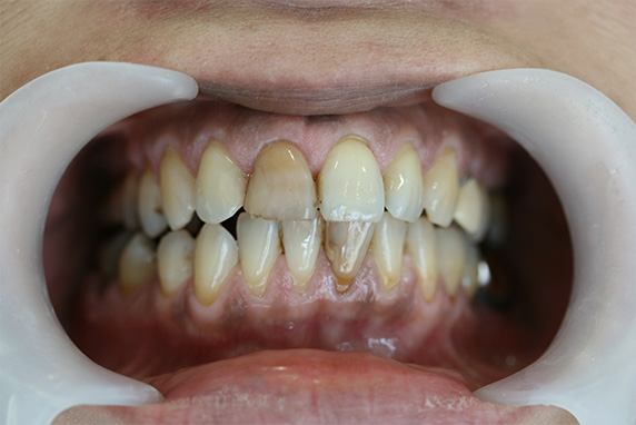 オールセラミッククラウン（e-max）,歯のエステの症例写真　オールセラミッククラウン（e-max）も施行,Before,ba_esthe03_b.jpg