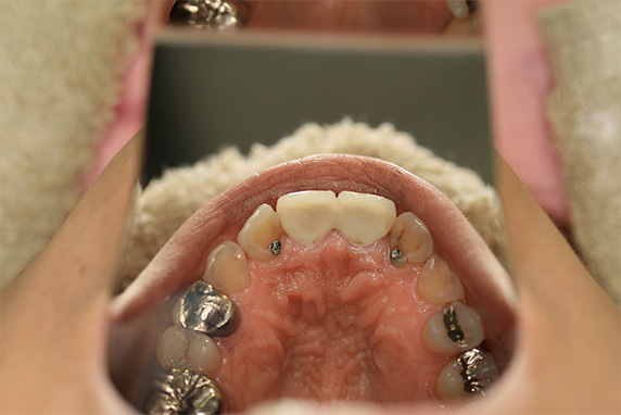 オールセラミッククラウン（e-max）,歯のエステの症例写真　オールセラミッククラウン（e-max）も施行,After,ba_esthe04_b.jpg