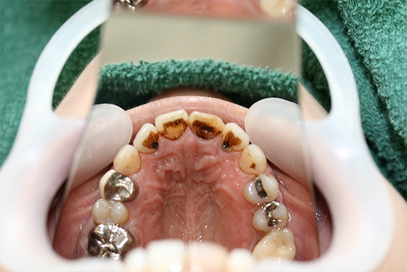 オールセラミッククラウン（e-max）,歯のエステの症例写真　オールセラミッククラウン（e-max）も施行,Before,ba_esthe04_b.jpg
