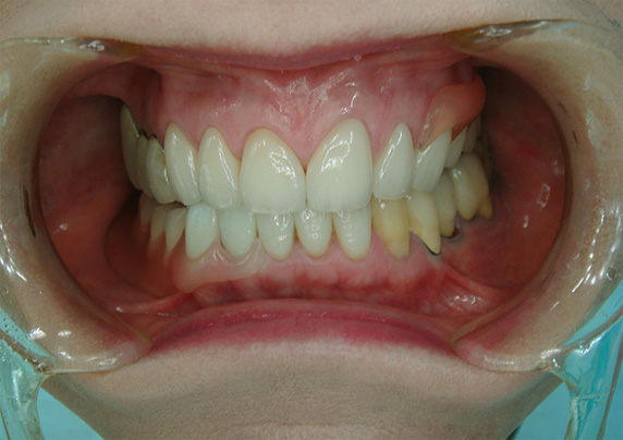 義歯・入れ歯の症例写真　オールセラミッククラウン（e-max）も施行,After,ba_denture01_a01.jpg