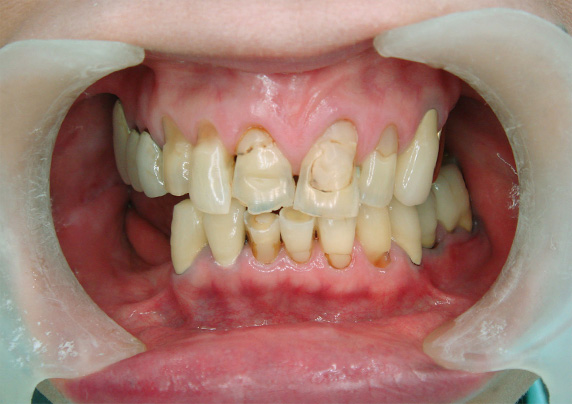 オールセラミッククラウン（e-max）,義歯・入れ歯,義歯・入れ歯の症例写真　オールセラミッククラウン（e-max）も施行,Before,ba_denture01_b.jpg