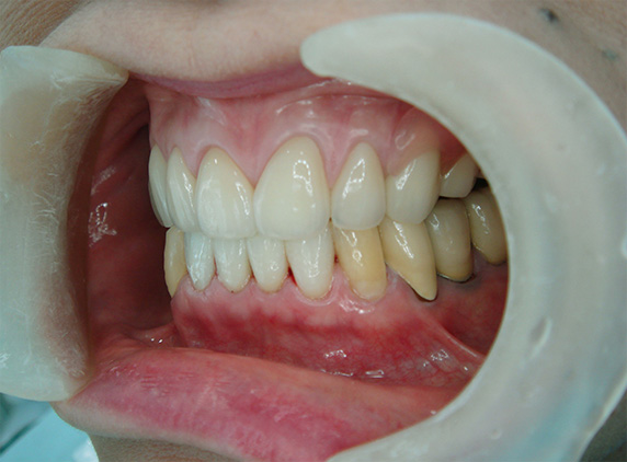 オールセラミッククラウン（e-max）,義歯・入れ歯の症例写真　オールセラミッククラウン（e-max）も施行,After,ba_denture02_b.jpg