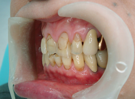 義歯・入れ歯,義歯・入れ歯の症例写真　オールセラミッククラウン（e-max）も施行,Before,ba_denture02_b.jpg