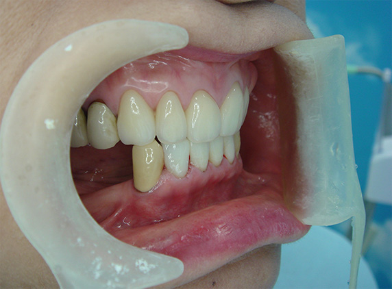義歯・入れ歯,義歯・入れ歯の症例写真　オールセラミッククラウン（e-max）も施行,After（義歯なし）,ba_denture03_b.jpg