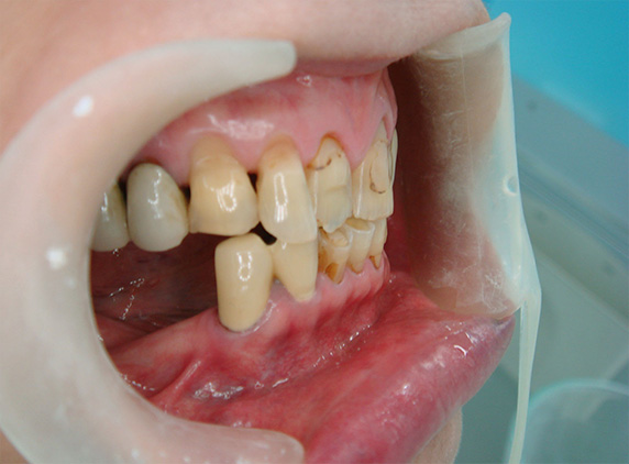 オールセラミッククラウン（e-max）,義歯・入れ歯の症例写真　オールセラミッククラウン（e-max）も施行,Before,ba_denture03_b.jpg