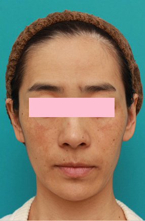 レーザートーニング（肝斑モード）の症例写真,After,ba_alextrivantage03_a01.jpg