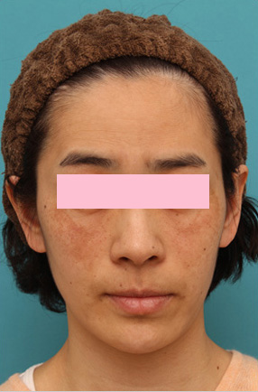 レーザートーニング（肝斑モード）の症例写真,Before,ba_alextrivantage03_b.jpg