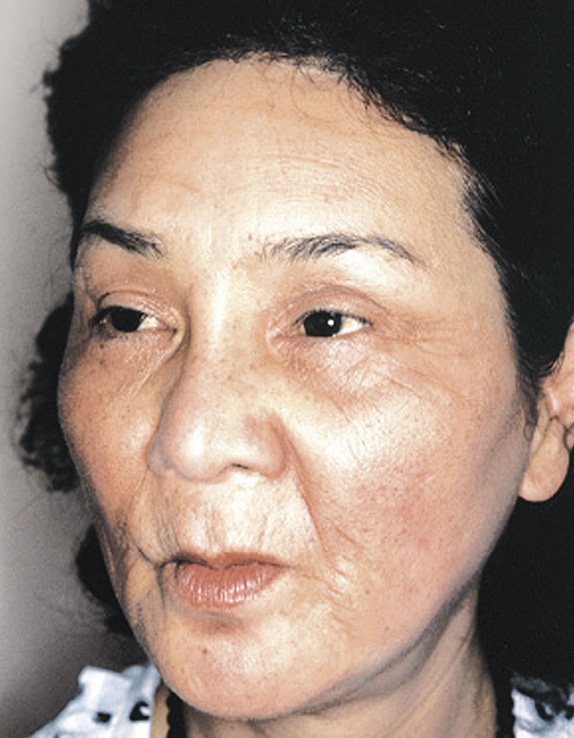 額リフト（額のしわ取り手術）,フルフェイスリフトを行った82歳女性の症例写真,Before,ba_facelift_pic13_b.jpg