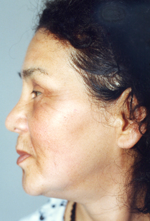 フルフェイスリフト,フルフェイスリフトを行った82歳女性の症例写真,Before,ba_facelift_pic15_b.jpg