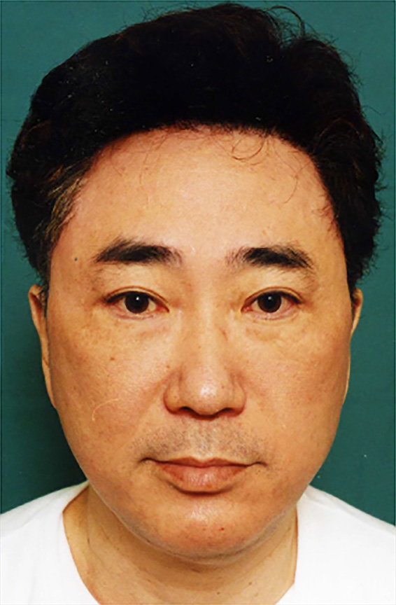 フルフェイスリフト,高須クリニック院長高須克弥のフルフェイスリフト症例写真,After（6ヶ月後）,ba_facelift_pic11_b.jpg