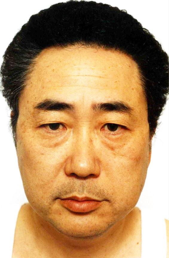 フルフェイスリフト,高須クリニック院長高須克弥のフルフェイスリフト症例写真,Before,ba_facelift_pic11_b.jpg