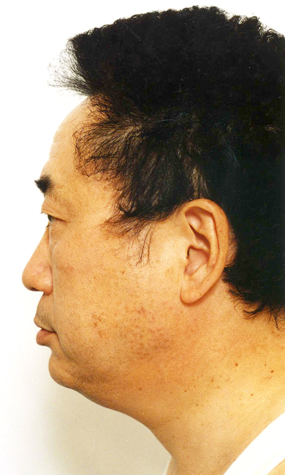 フルフェイスリフト,高須クリニック院長高須克弥のフルフェイスリフト症例写真,Before,ba_facelift_pic12_b.jpg