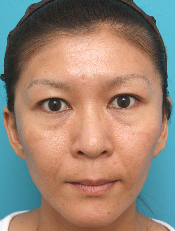 ミディアムフェイスリフト,ミディアムフェイスリフトの症例 顔のたるみを除去した女性,After（メイクなし）,ba_mediumlift_pic03_b.jpg