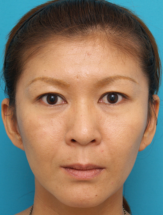 ミディアムフェイスリフト,ミディアムフェイスリフトの症例 顔のたるみを除去した女性,After（メイクあり）<br/>
（3ヶ月後）,
