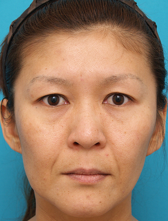 ミディアムフェイスリフト,ミディアムフェイスリフトの症例 顔のたるみを除去した女性,Before,ba_mediumlift_pic03_b.jpg