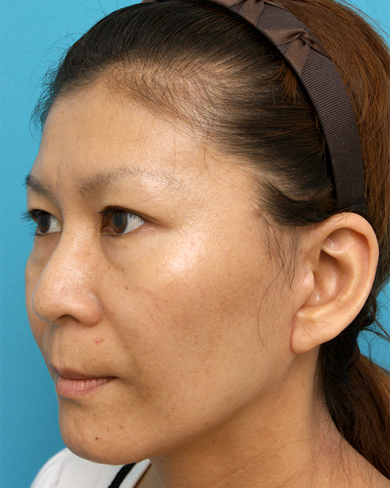 ミディアムフェイスリフト,ミディアムフェイスリフトの症例 顔のたるみを除去した女性,After（メイクなし）,ba_mediumlift_pic04_b.jpg