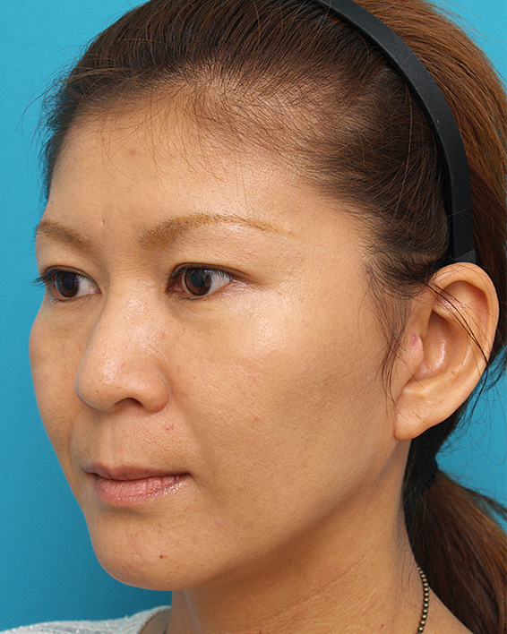 ミディアムフェイスリフト,ミディアムフェイスリフトの症例 顔のたるみを除去した女性,After（メイクあり）<br/>
（3ヶ月後）,