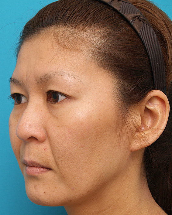 症例写真,ミディアムフェイスリフトの症例 顔のたるみを除去した女性,Before,ba_mediumlift_pic04_b.jpg