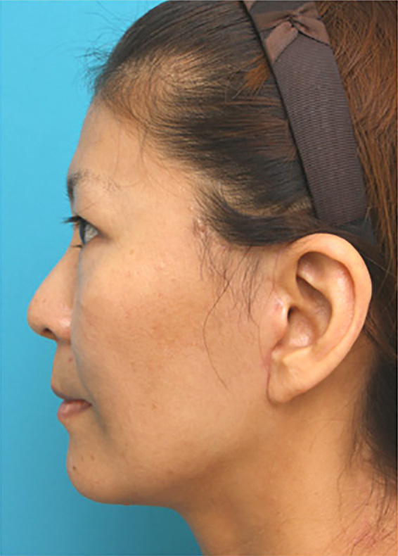 ミディアムフェイスリフト,ミディアムフェイスリフトの症例 顔のたるみを除去した女性,After（メイクなし）,ba_mediumlift_pic05_b.jpg
