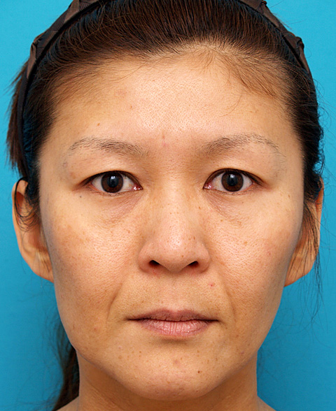 ミディアムフェイスリフト,ミディアムフェイスリフトの症例 顔のたるみを除去した女性,施術前,mainpic_mediumlift01a.jpg