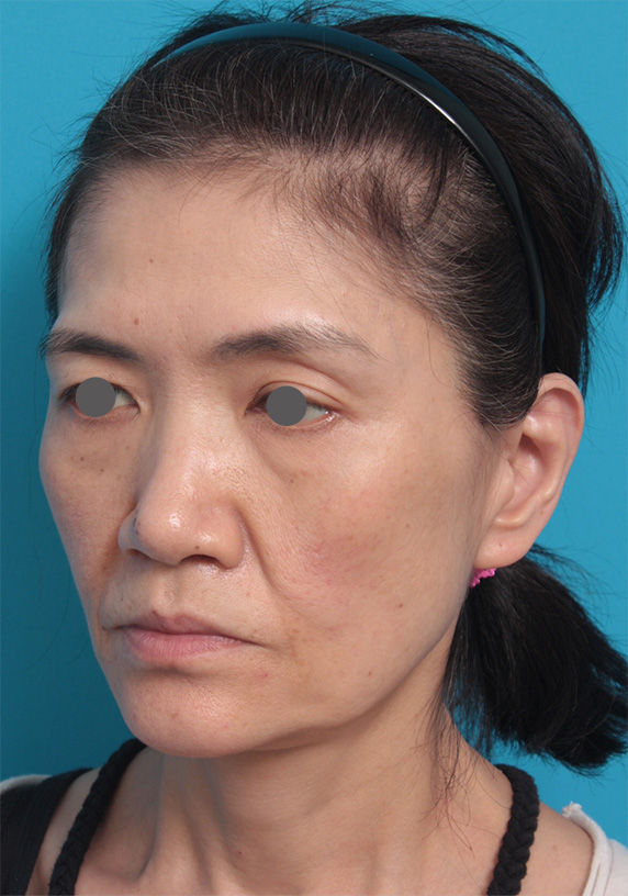 ミディアムフェイスリフト,50代女性に行ったミディアムフェイスリフト症例写真,Before,ba_mediumlift_pic10_b.jpg