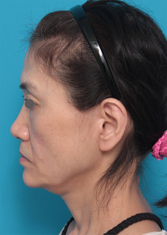 ゴルゴライン,50代女性に行ったミディアムフェイスリフト症例写真,Before,ba_mediumlift_pic11_b.jpg