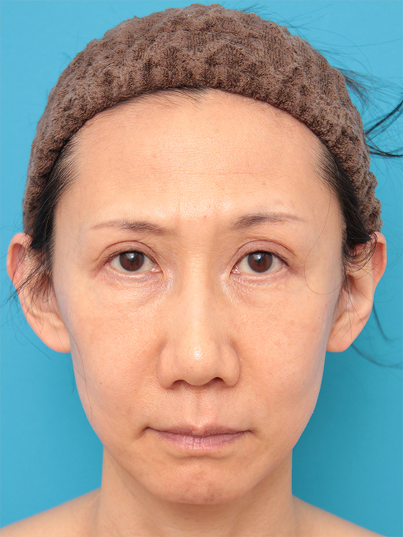 ミディアムフェイスリフト,40代女性のミディアムフェイスリフト症例写真,After（6ヶ月後）,ba_mediumlift12_a01.jpg