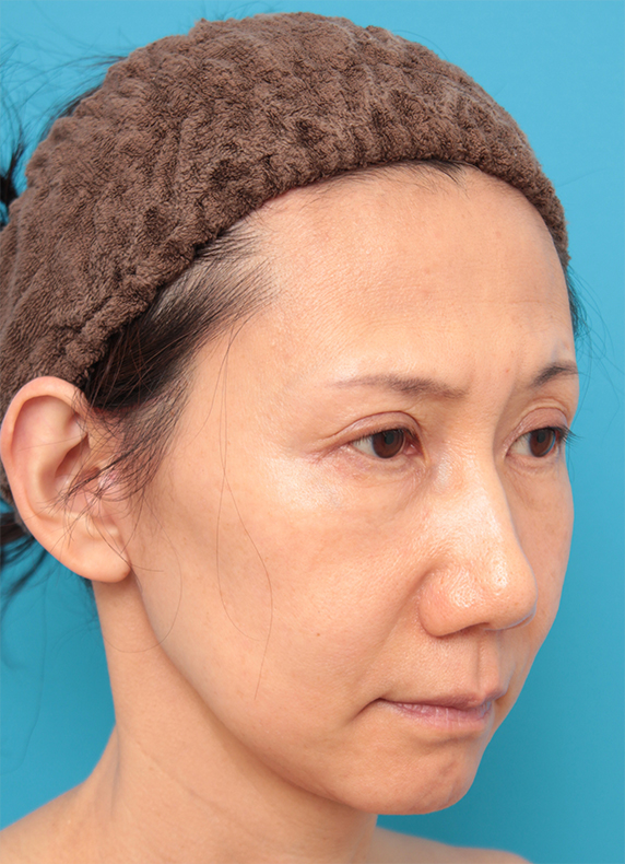 ミディアムフェイスリフト,40代女性のミディアムフェイスリフト症例写真,After（6ヶ月後）,ba_mediumlift13_b.jpg