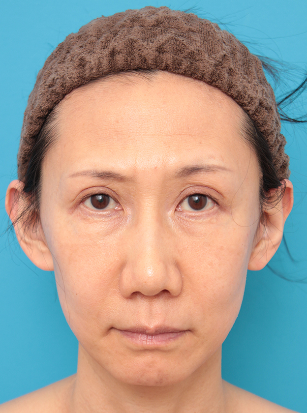 ミディアムフェイスリフト,40代女性のミディアムフェイスリフト症例写真,6ヶ月後,mainpic_mediumlift03c.jpg