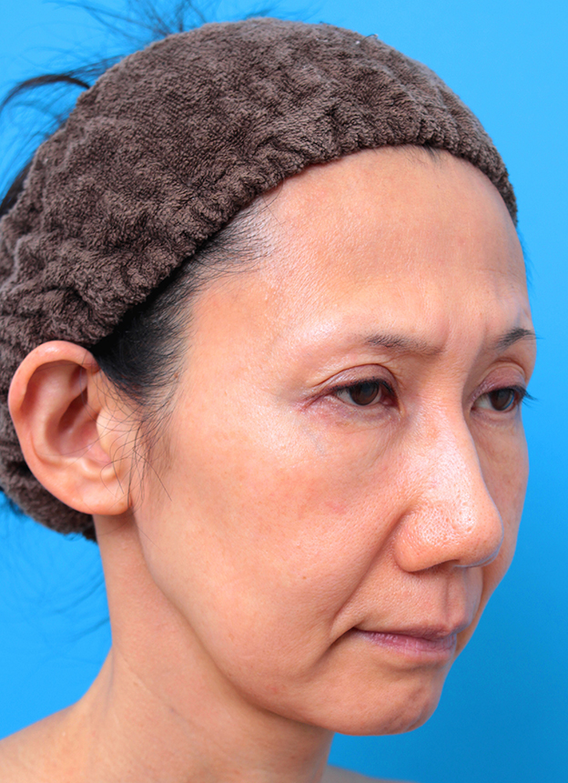 ミディアムフェイスリフト,40代女性のミディアムフェイスリフト症例写真,手術前,mainpic_mediumlift03d.jpg