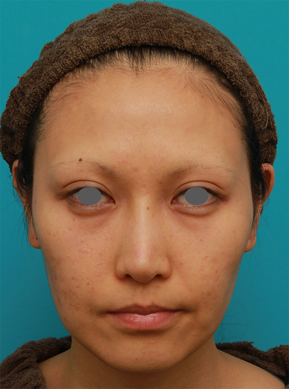 ミディアムフェイスリフト,ミディアムフェイスリフトで頬のたるみをリフトアップさせた20代後半女性の症例写真の術前術後画像,Before,ba_mediumlift15_b.jpg